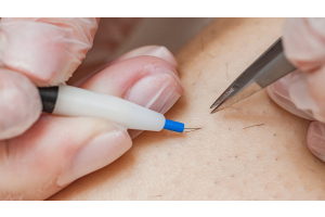 electrolysis pros cons nyc