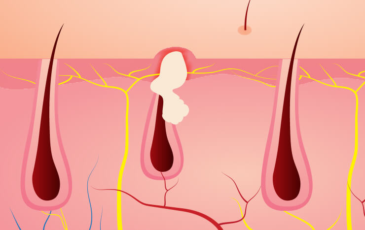 Ingrowns - the Misbehaving Hair