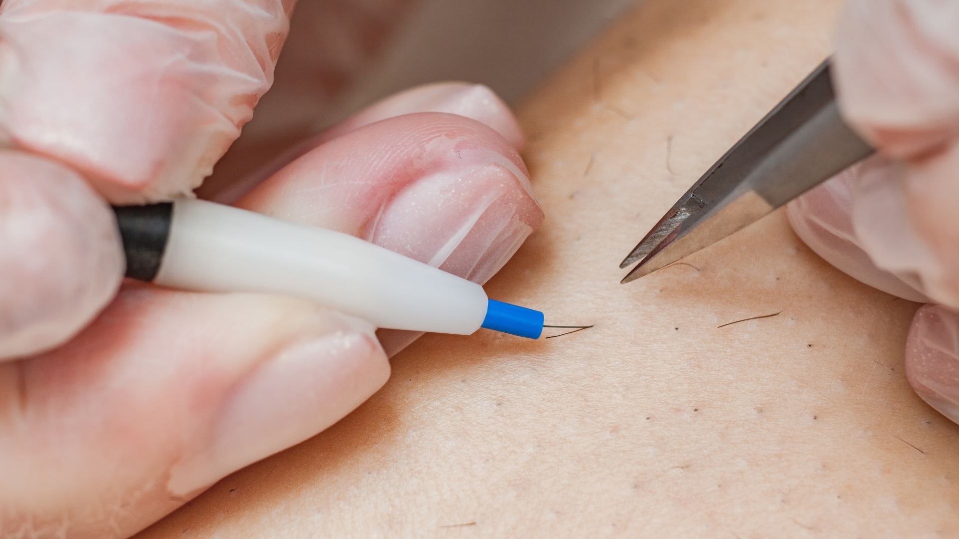 electrolysis pros cons nyc