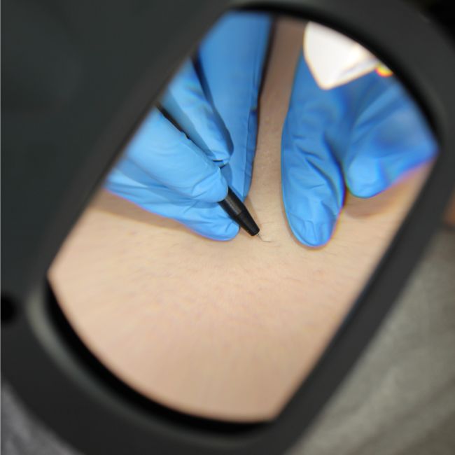 permanent hair removal NYC